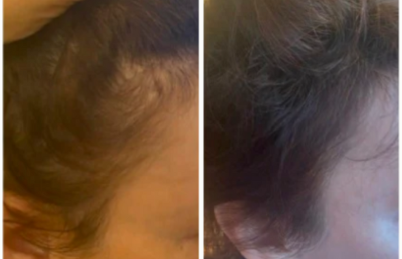 Temples and forehead border