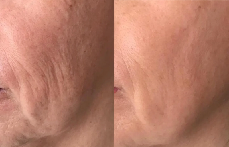Deep wrinkles on the cheek