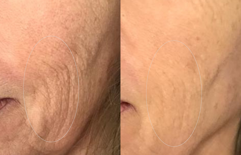 Skin firmness and elasticity