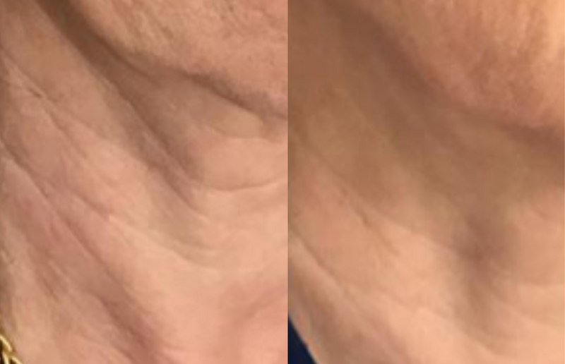 Firmer neck and décolleté