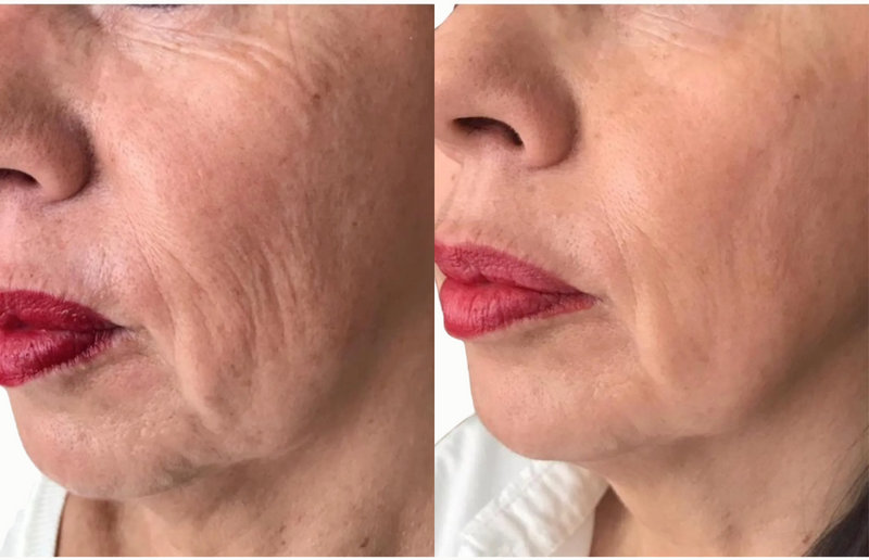 Rides des joues et contour buccal