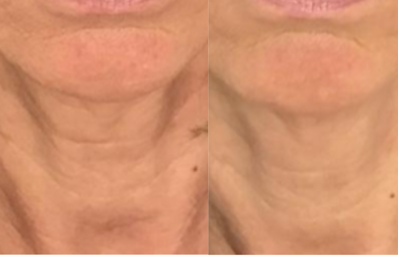 Overall rejuvenation of the lower face