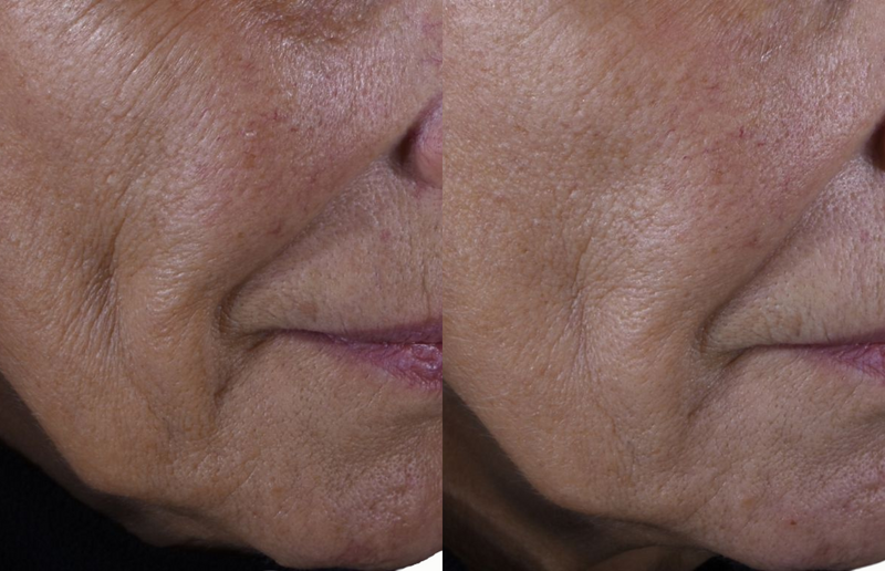 Wrinkles around the mouth