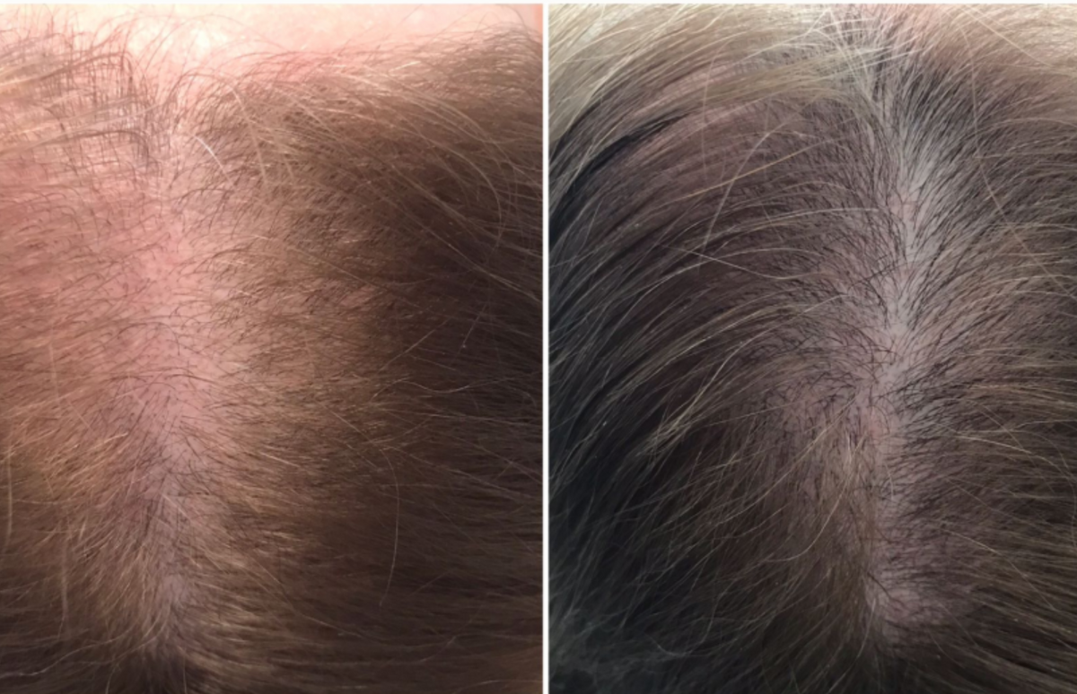 Top of the head / Center part - Before