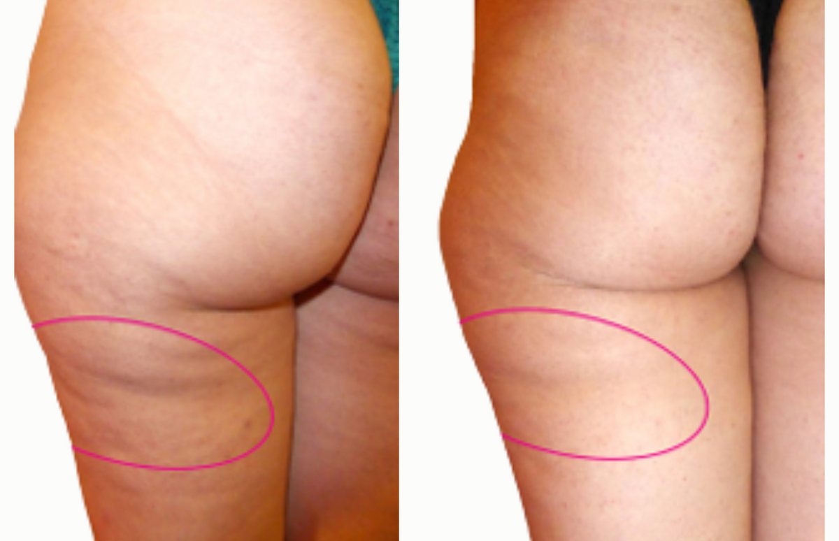 Posterior thigh - Before