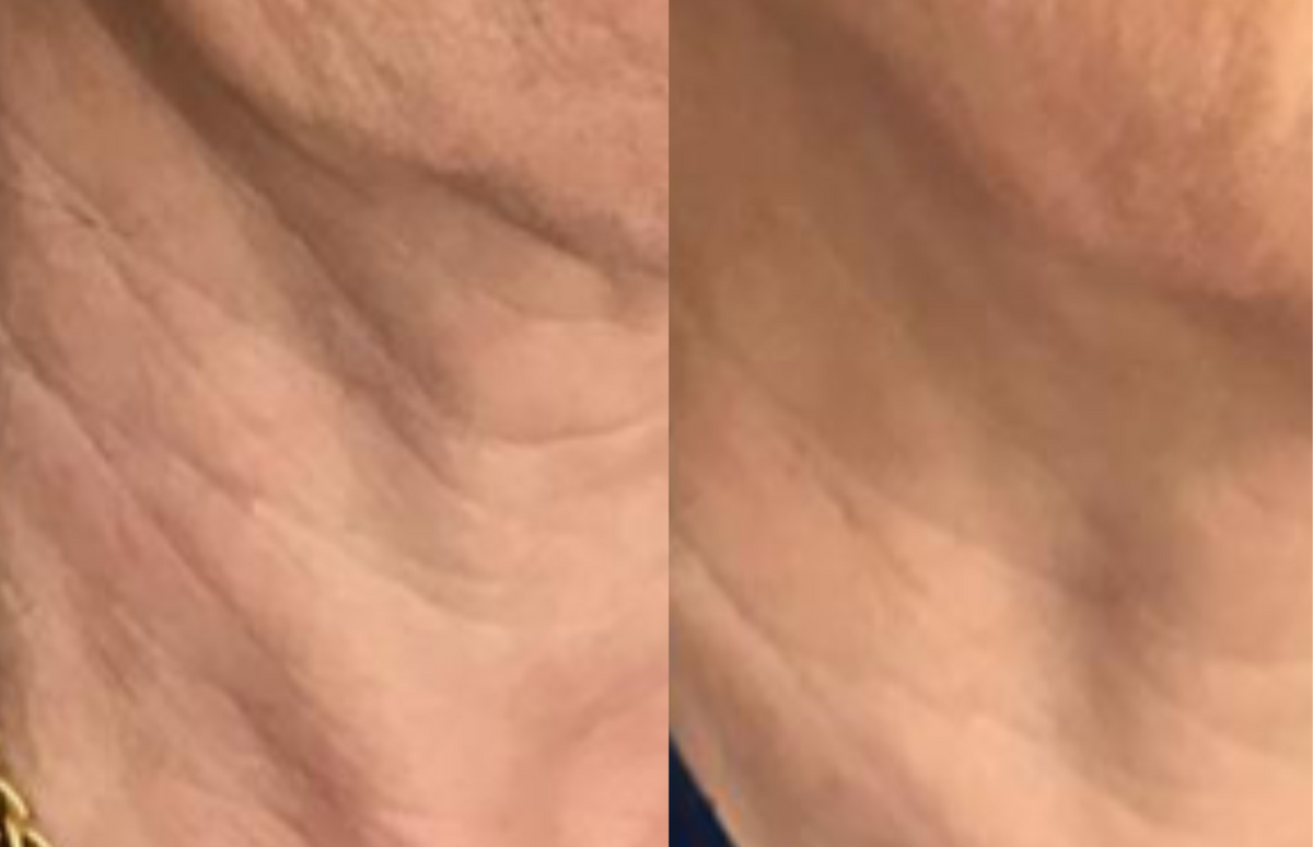 Firmer neck - Before