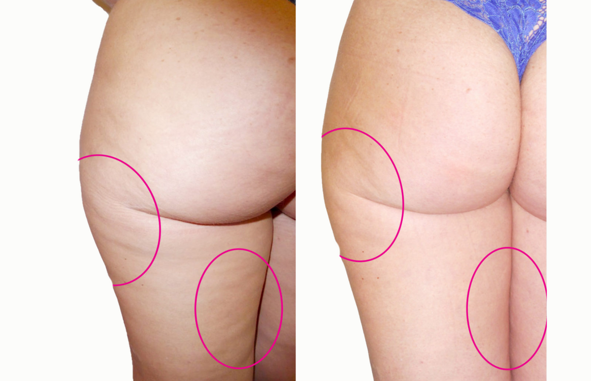 Buttocks and upper thighs - Before