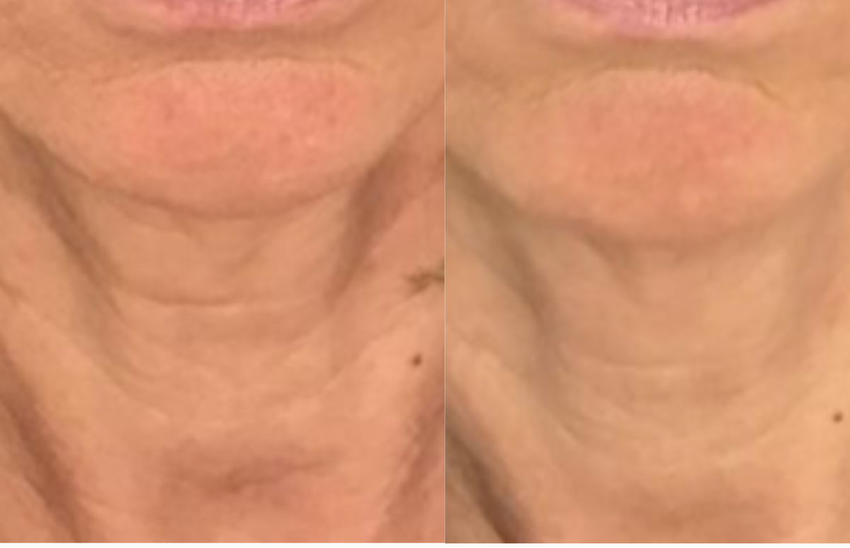 Overall rejuvenation of the lower face - Before