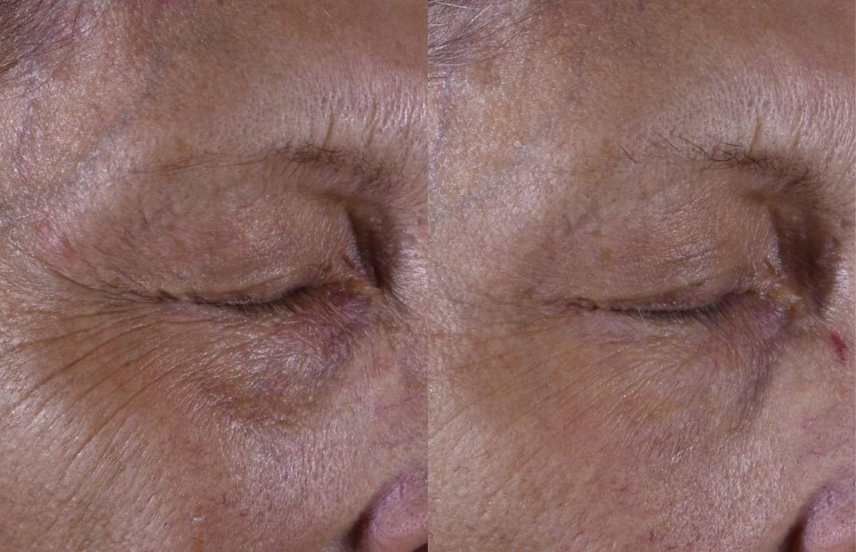 Periocular wrinkles - Before