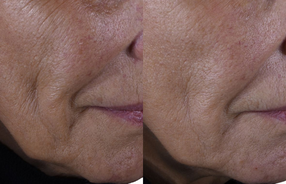 Mouth contour wrinkles - Before