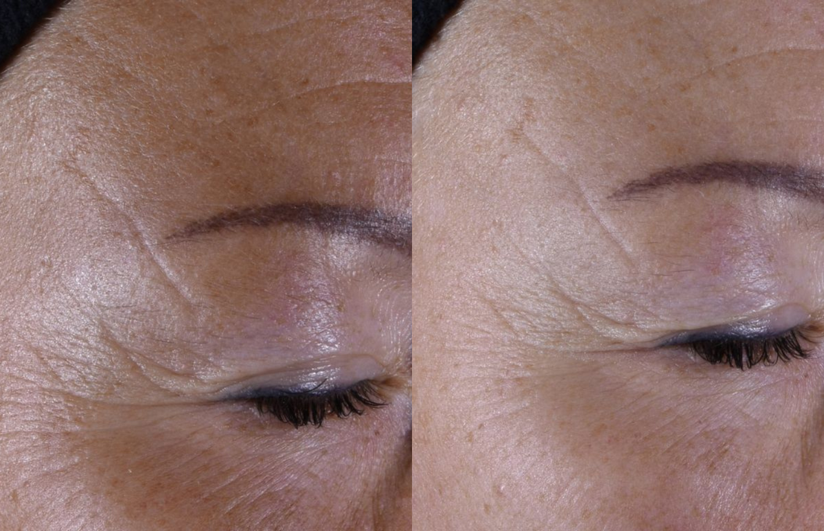 Crow's feet - Before