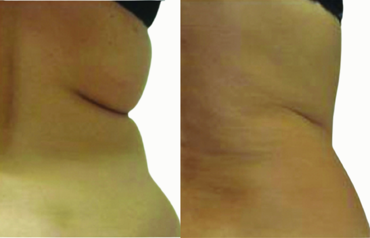 Lower back and love handles - Before