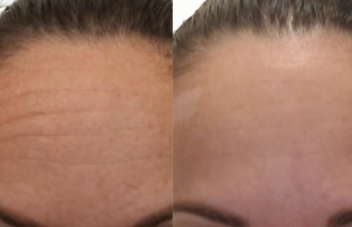 Forehead smoothing - Before