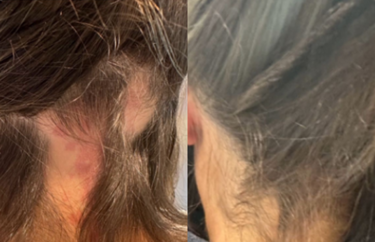 Nape & targeted care - Before