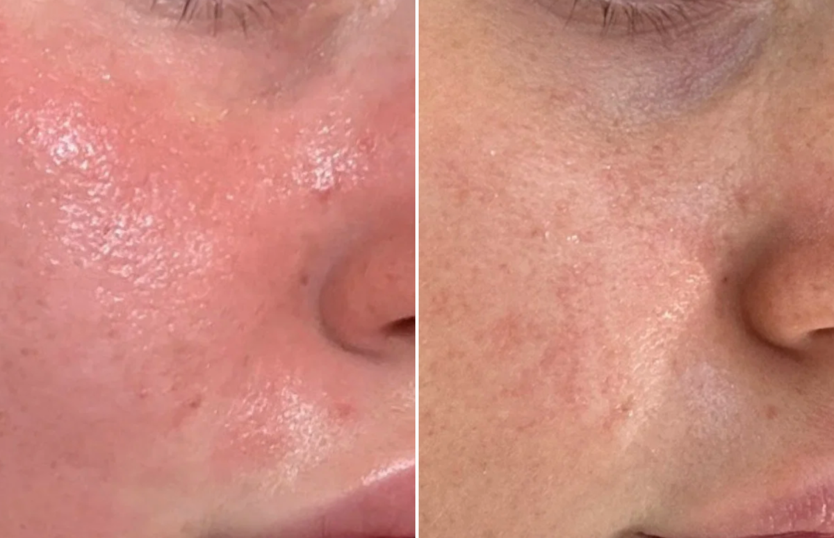 Visibly reduced acne, redness, and eczema - Before