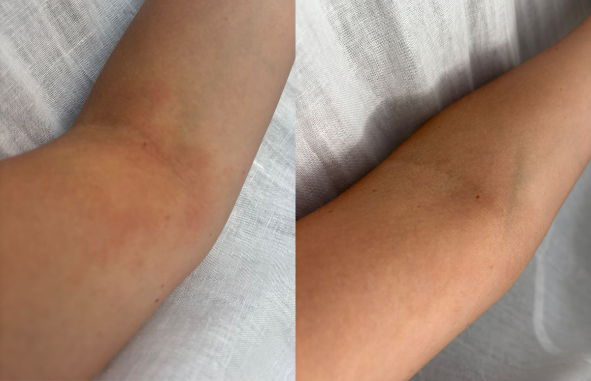 Arm eczema - Before