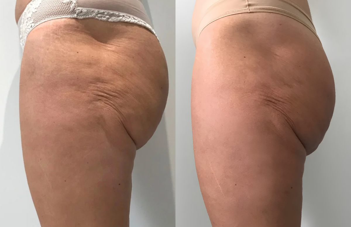 Thigh side - Before